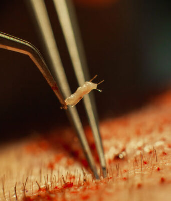 La greffe de cheveux : restaurer la confiance avec une solution durable